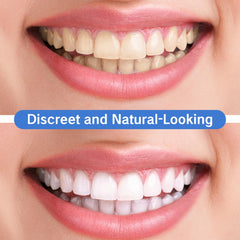 Easy-to-use snap-on dental covers for daily wear