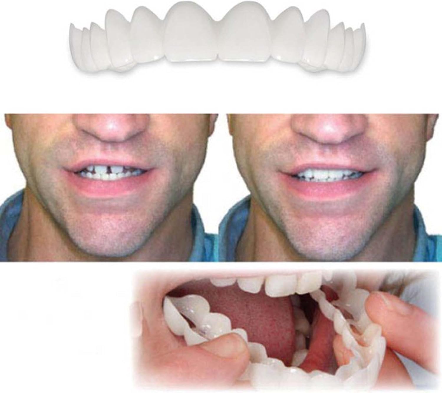 Before and after concept with natural white aligners