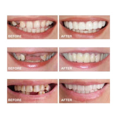 Discreet white temporary smile enhancer