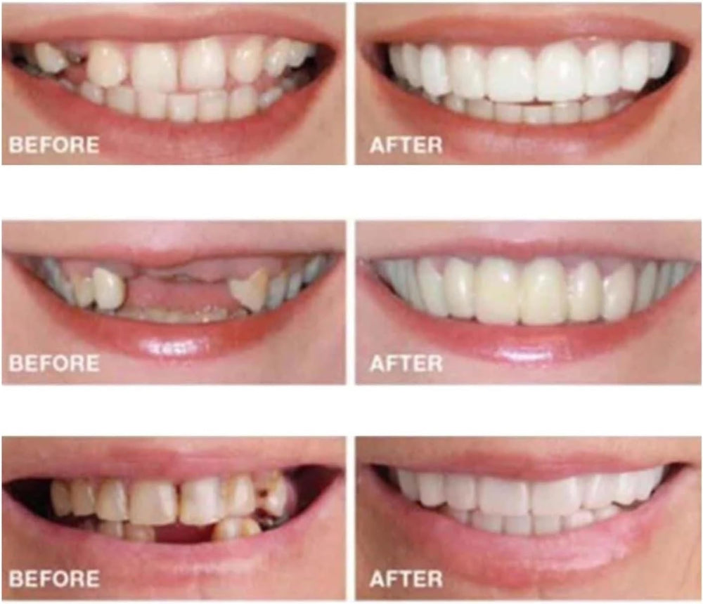 Open storage case with two pairs of temporary smile devices