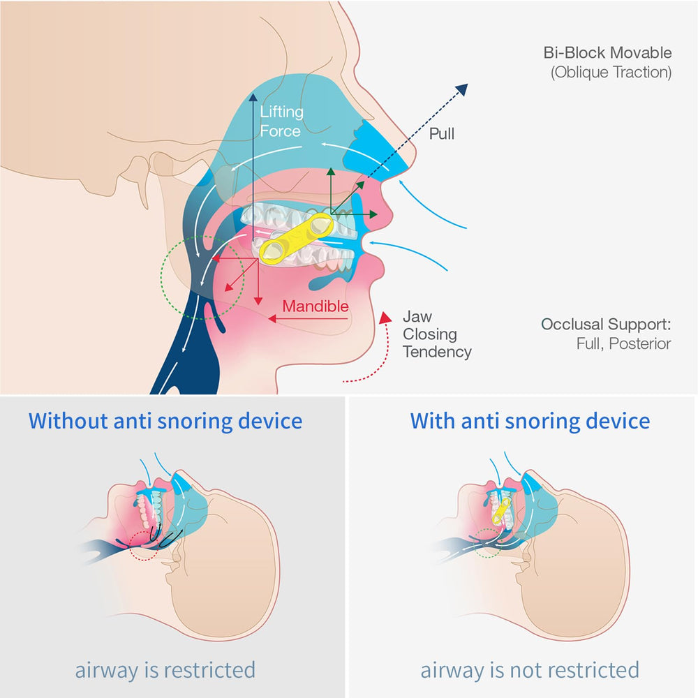 Latex-free replacement straps for Meyson EMA