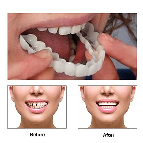 Smile aligners showing natural look and comfortable fit