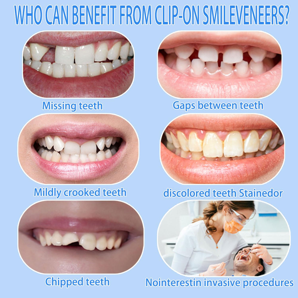 Adjustable veneer kit for personalized fit