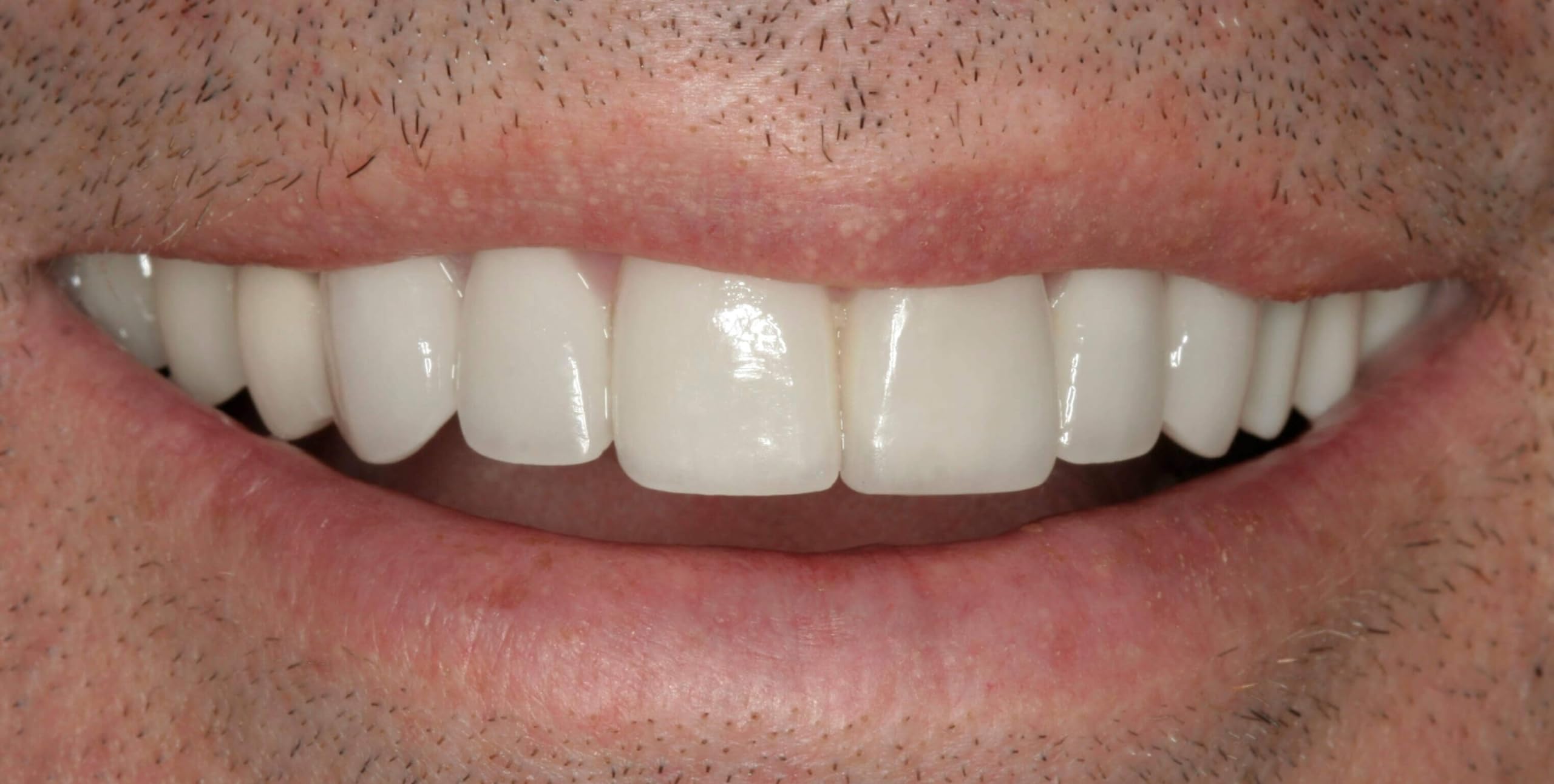 Affordable home denture solution