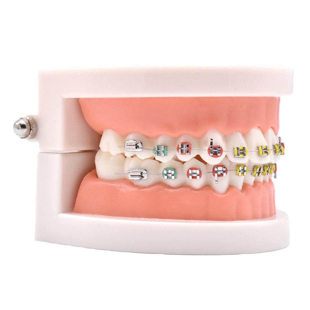 Ceramic brackets with colored ligature ties on teeth
