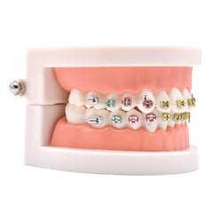Ceramic brackets with colored ligature ties on teeth