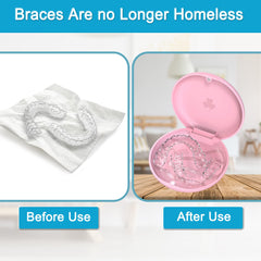 Open ARGOMAX aligner case showing interior space