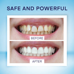 Close-up of whitening pen tip applying gel to tooth