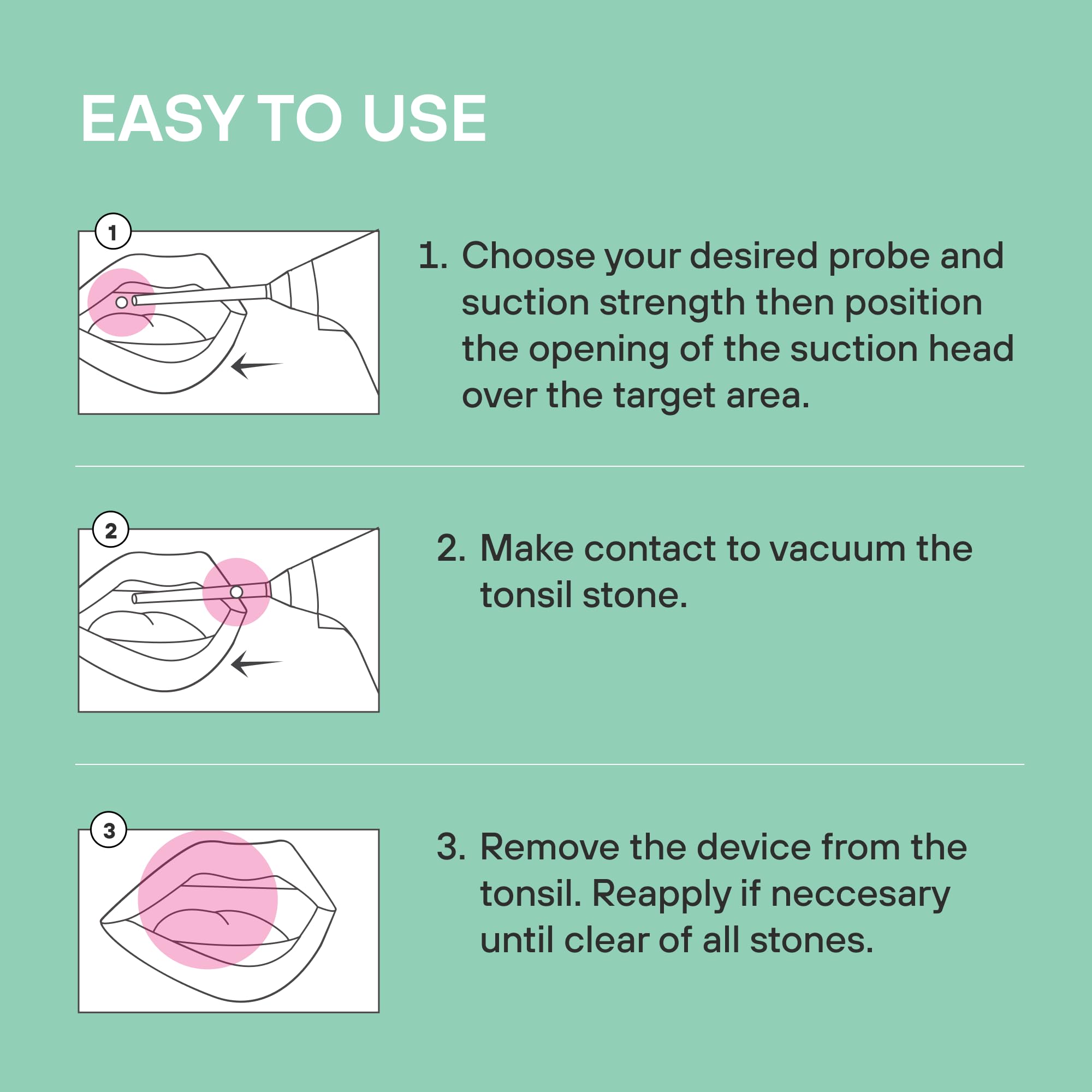 At-home tonsil stone removal kit ready for use.