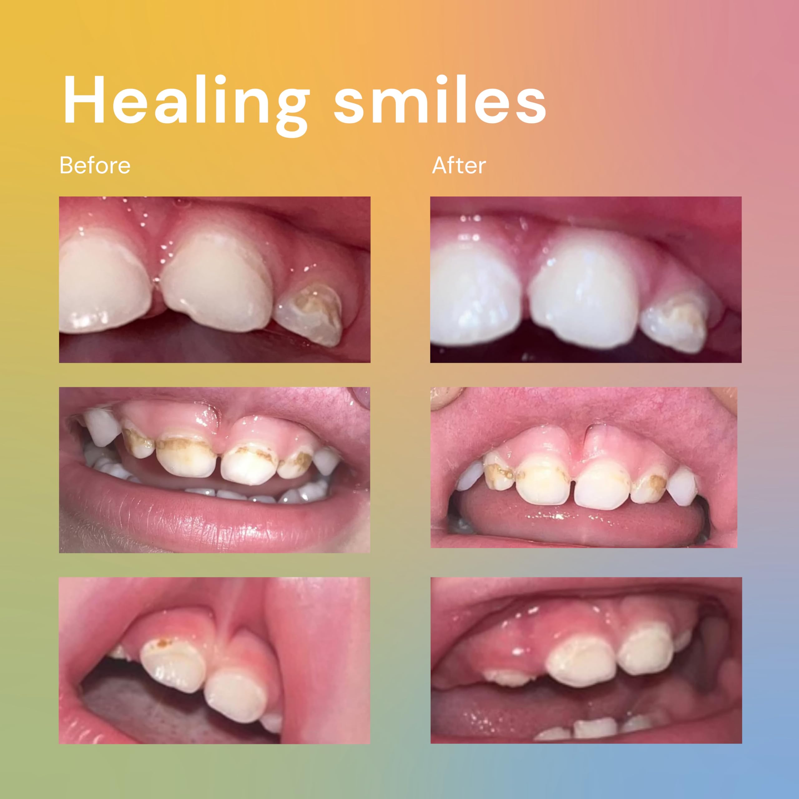 Mineral-rich spot treatment for dental care