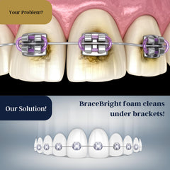 Orthodontic braces whitening care kit