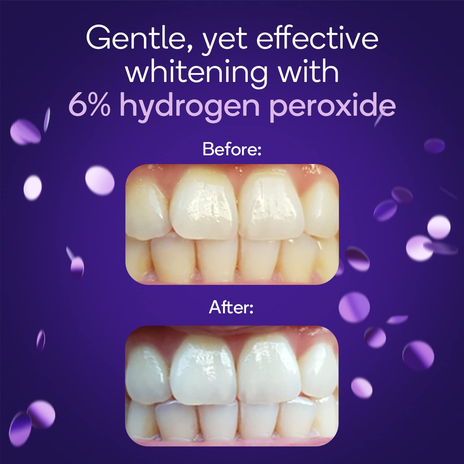 15 minute whitening results illustration