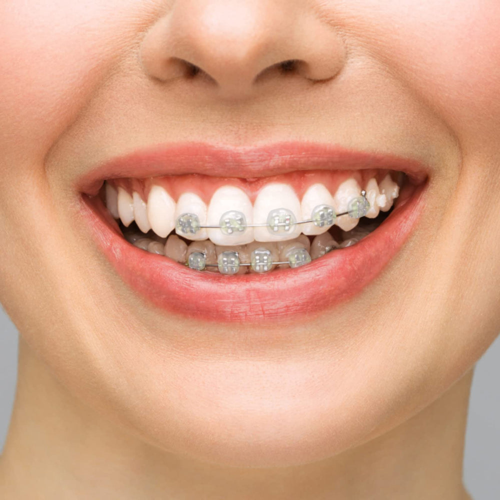 BVN braces wax with clear, tooth-colored wax