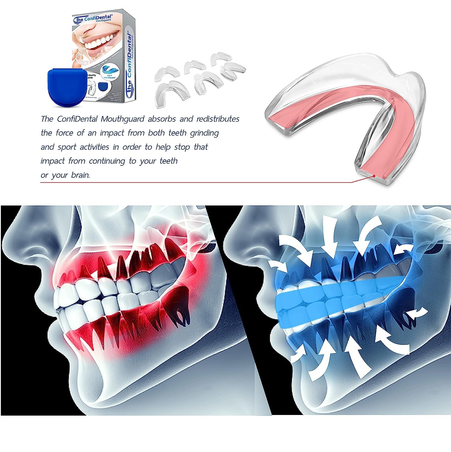Boil-and-bite molding instructions for ConfiDental night guards