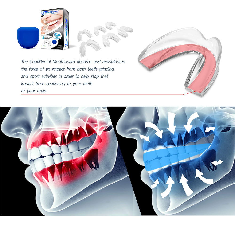 ConfiDental step-by-step molding instructions