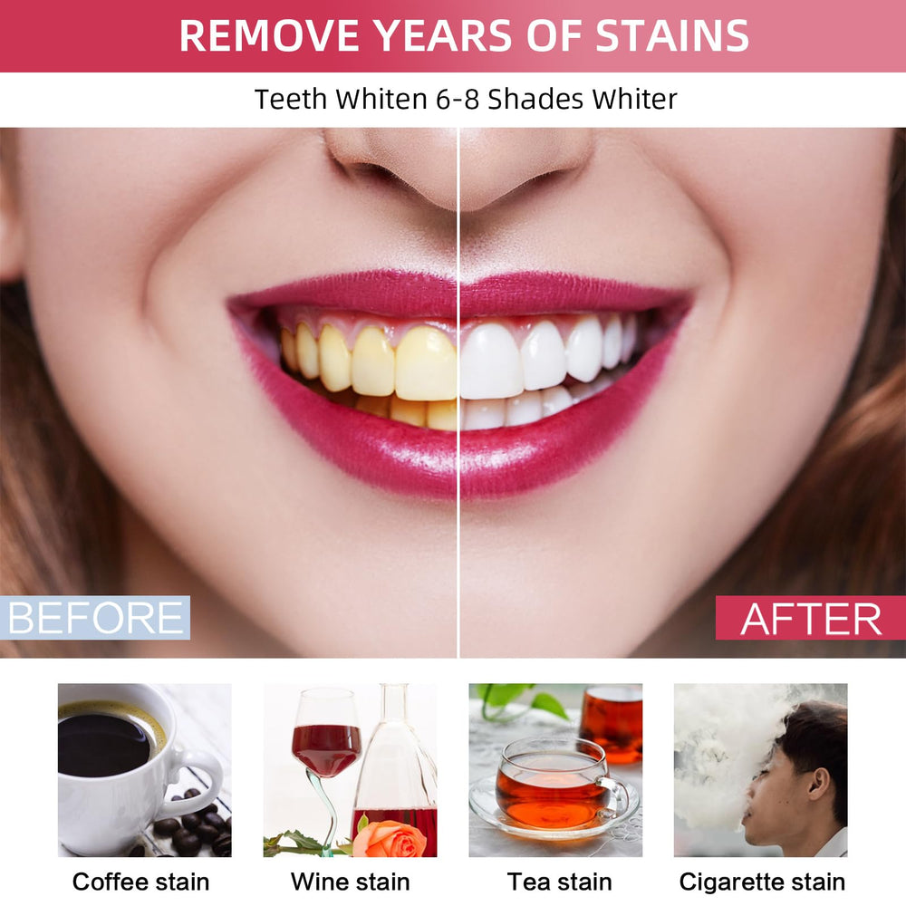 Custom mouth trays for comfortable at-home whitening