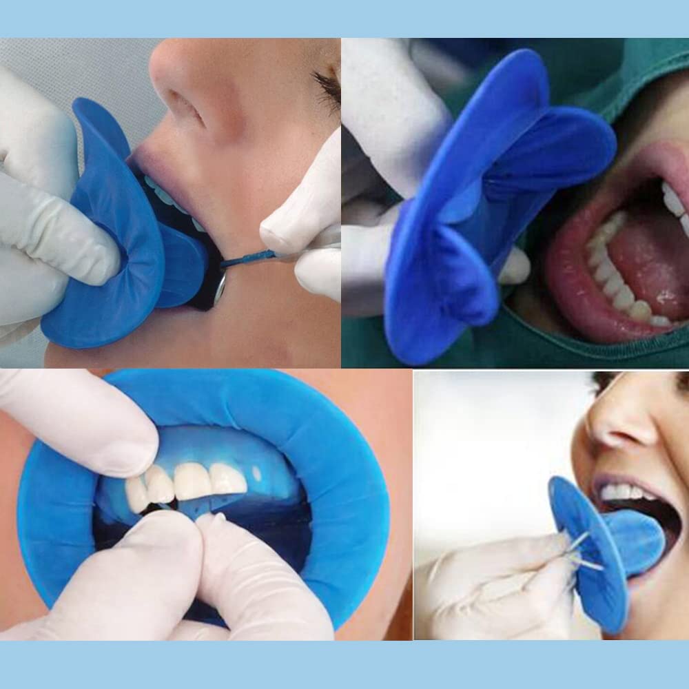 Mouth open during teeth whitening using blue dental dam cheek retractors