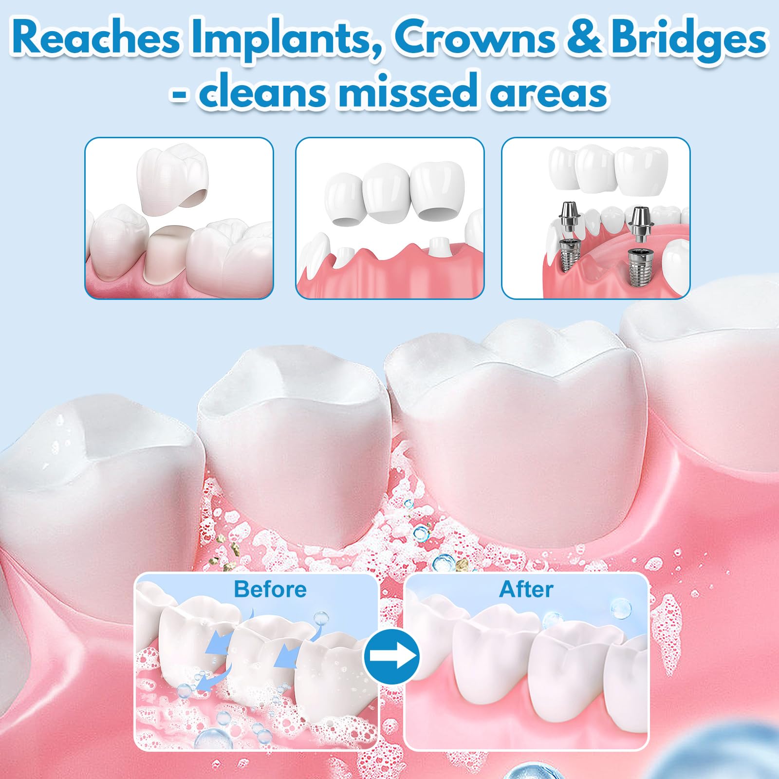 Close-up of foam cleaning implants, crowns and bridges