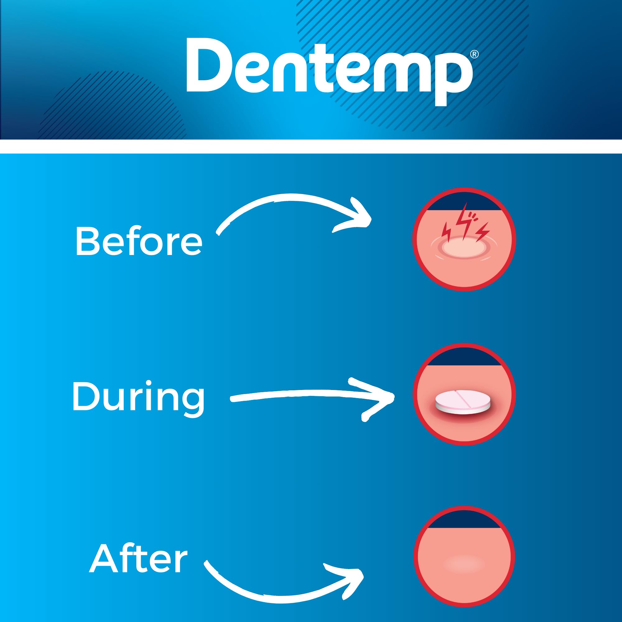 Relief for up to 12 hours with Dentemp Canker Cover