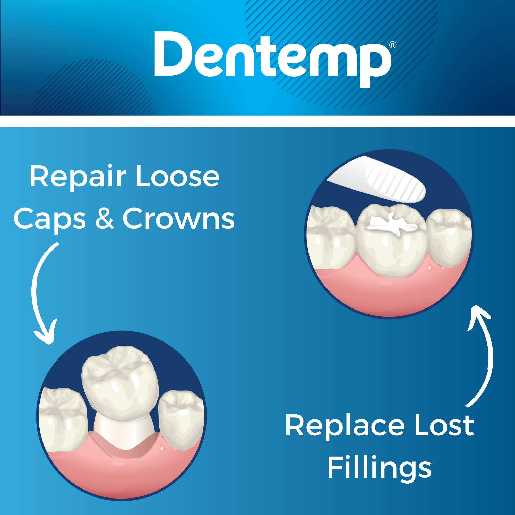 Dentemp temporary dental filling kit being applied in a cavity