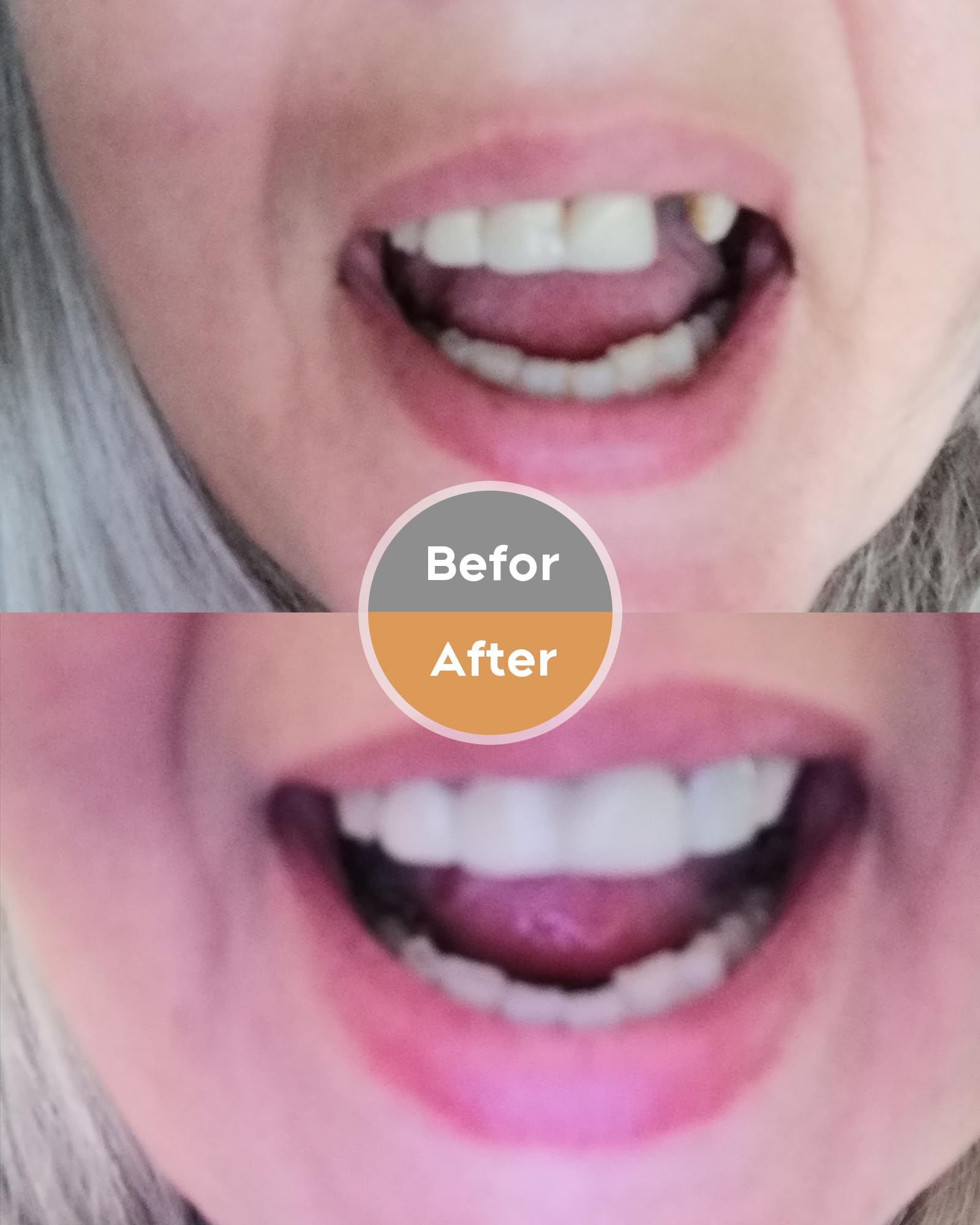 Care and use of the DIY dentures kit to maintain your smile