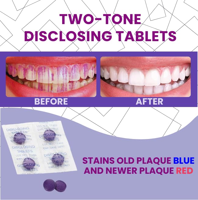 Two-tone red and blue plaque-disclosing stains on teeth