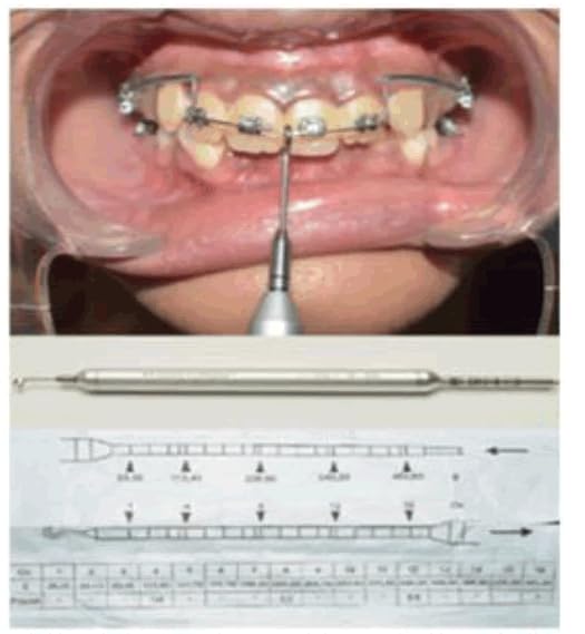 Dontrix gauge in orthodontic application demonstration