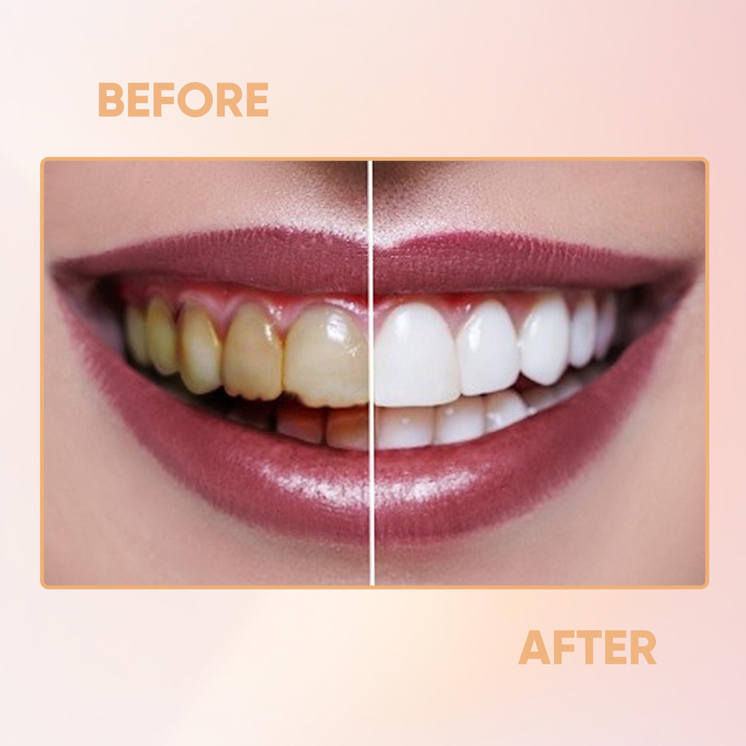 Veneers concealing chipped or missing teeth