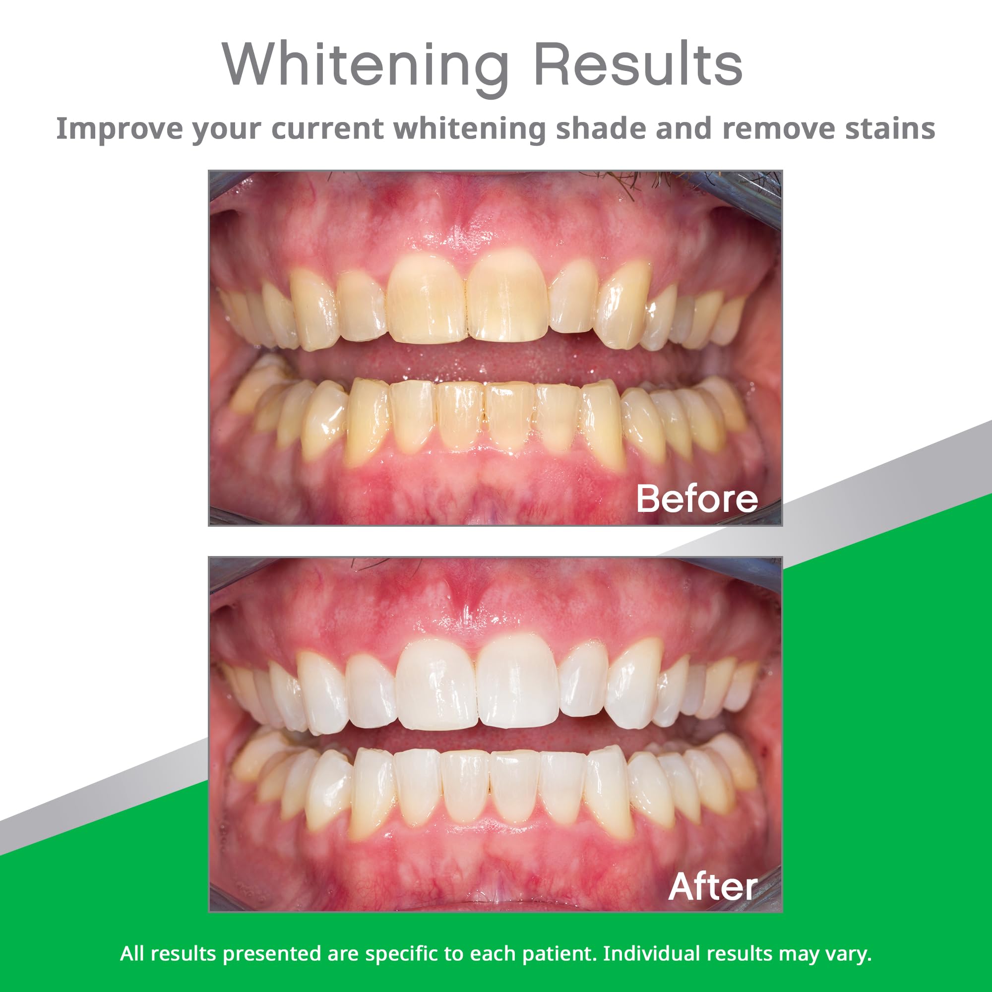 Prefilled whitening trays top and bottom for 10 treatments