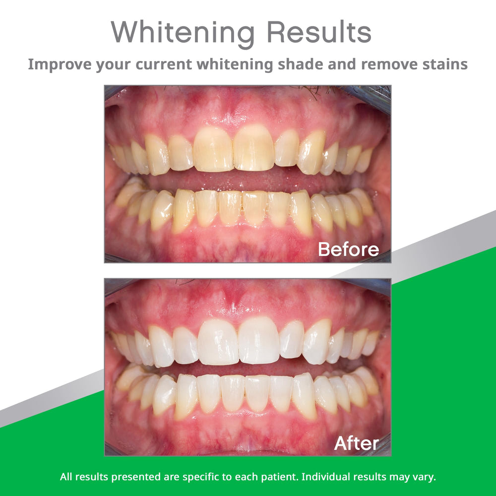 Prefilled whitening trays top and bottom for 10 treatments