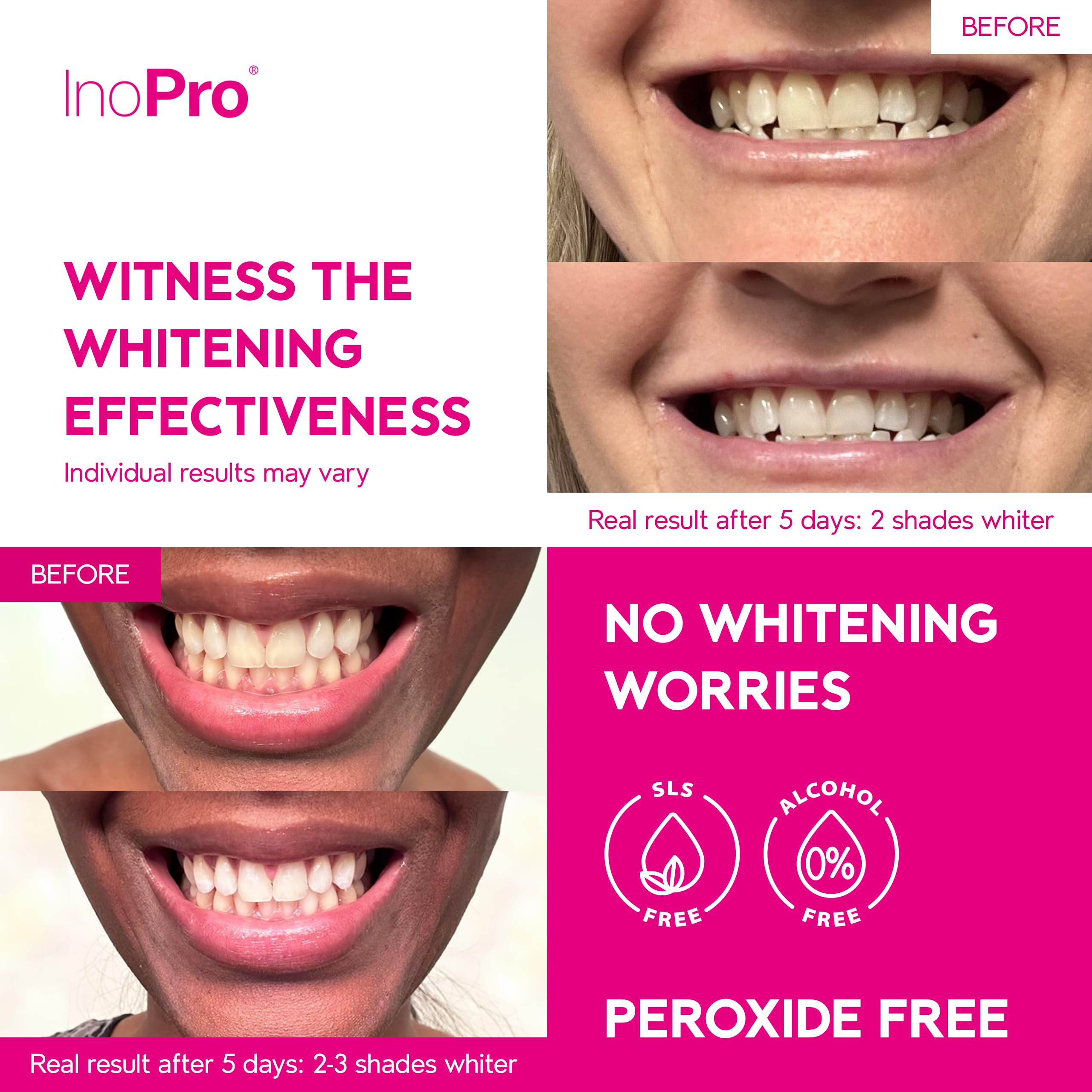 Close up of whitening strip applied to tooth
