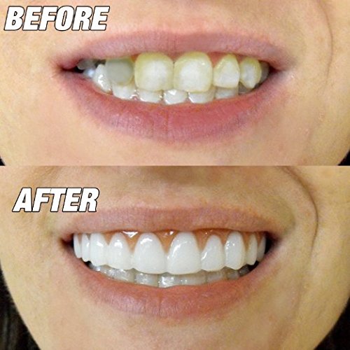Front view of Instant Smile Comfort Fit showing fit and subtle imperfections