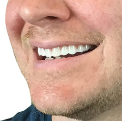 Bright White coloring resists staining on upper veneer