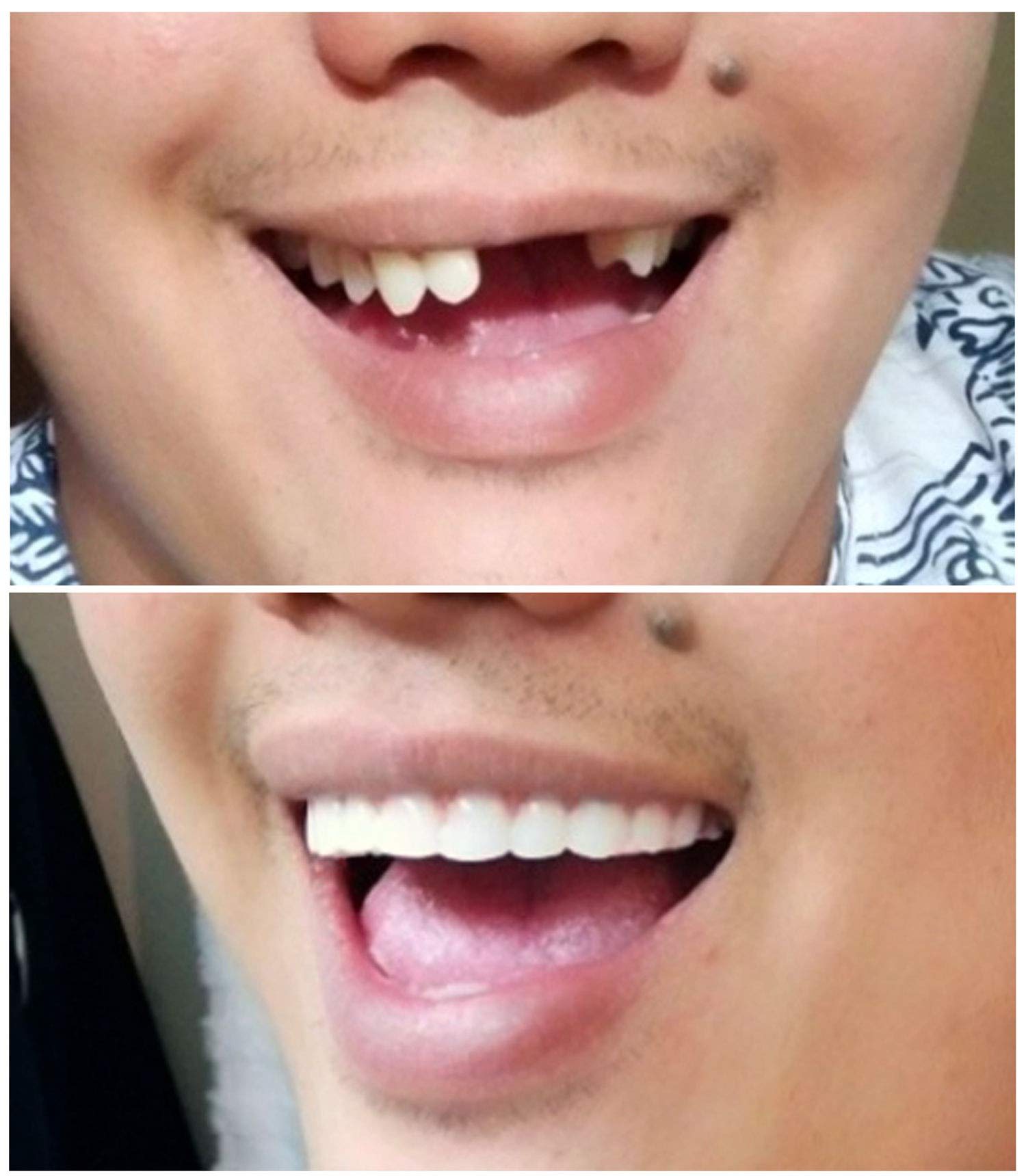 Person wearing Instant Smile Comfort Fit Flex upper veneer with natural smile