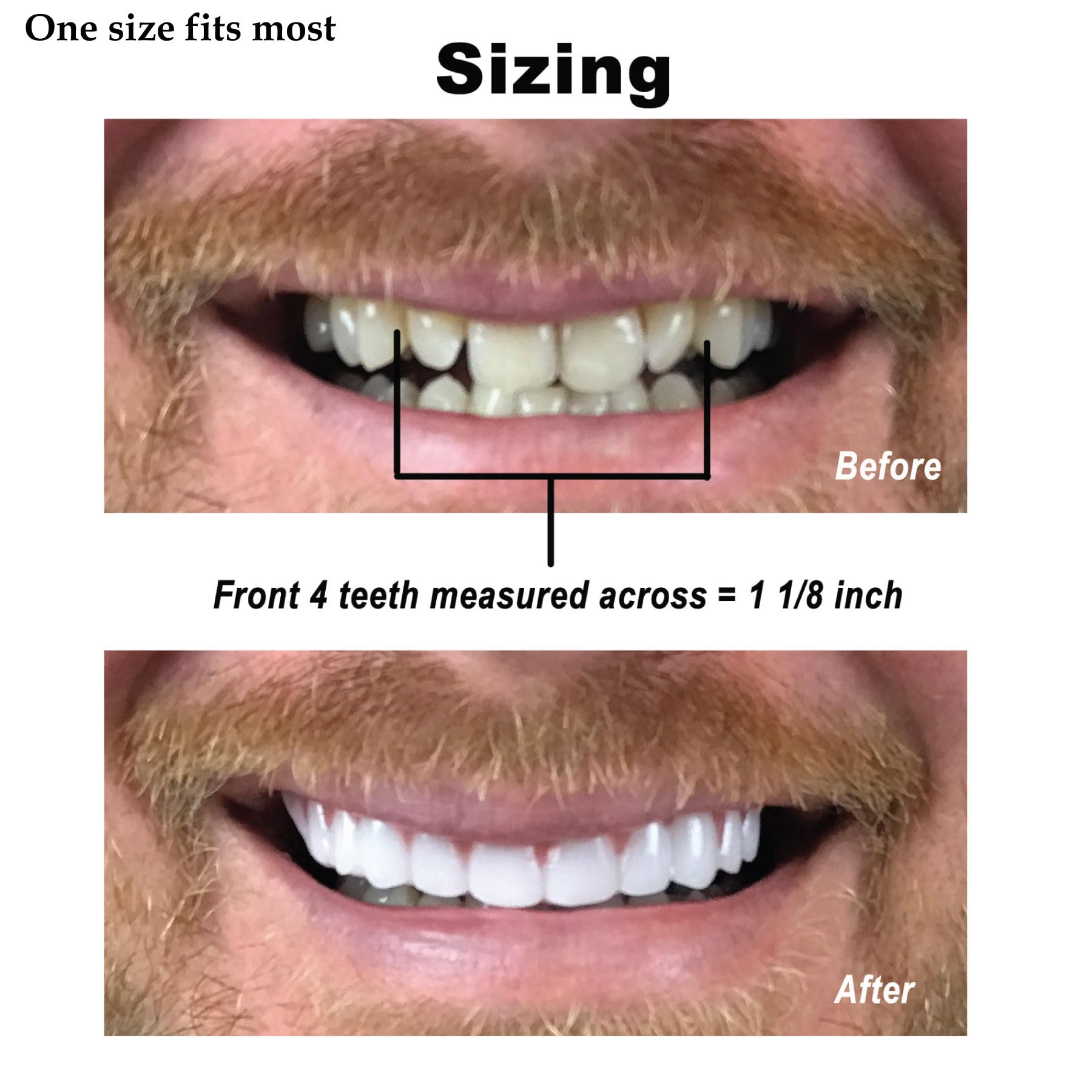 Natural-looking upper veneer applied for a discreet smile