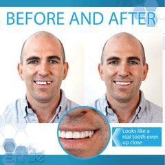 Customizable teeth pieces in Instant Smile kit