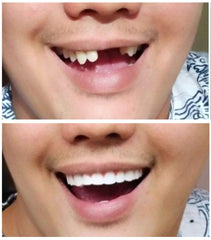 Reusable and durable lower teeth with storage