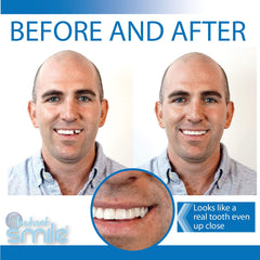 Demonstration of use for missing upper or lower tooth with customizable trimming