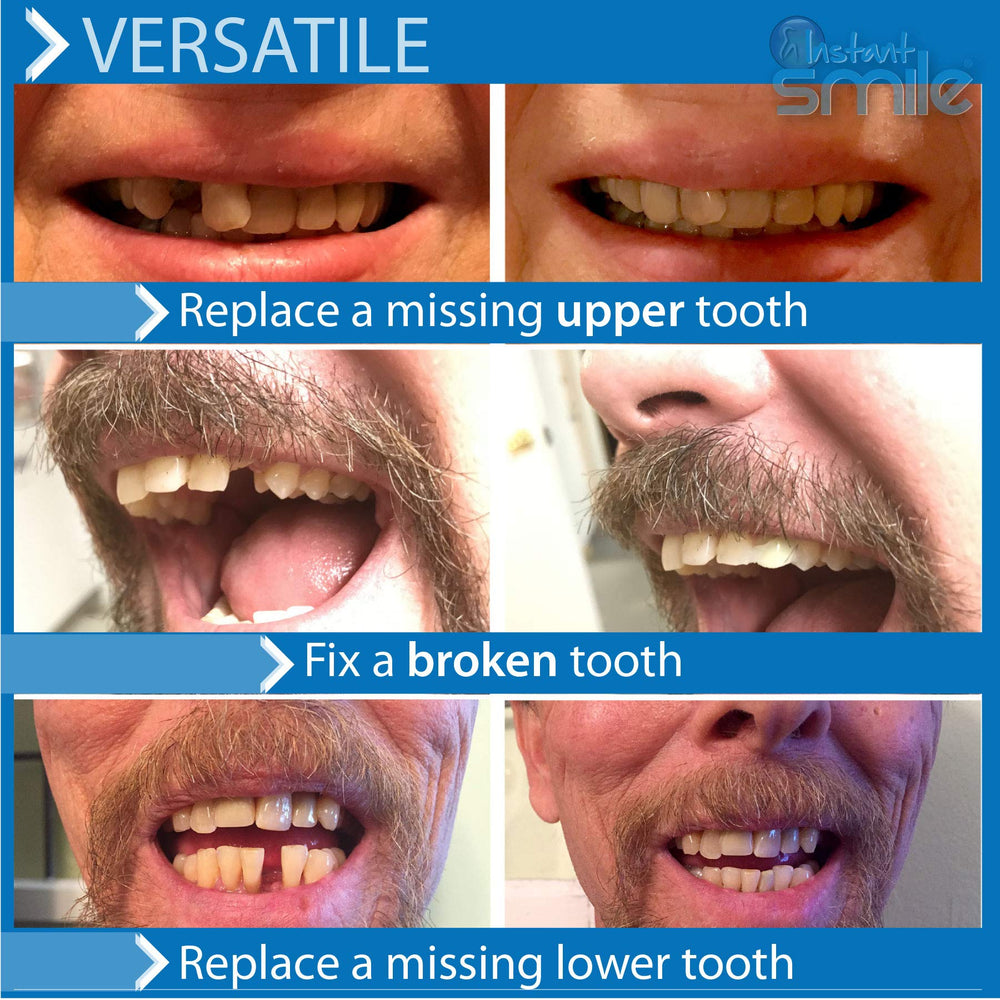 Realistic temporary tooth molded in the shape of an actual tooth