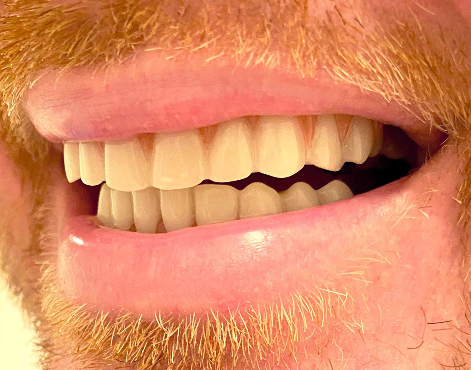 One size fits most dental flex teeth for missing, broken, or stained teeth
