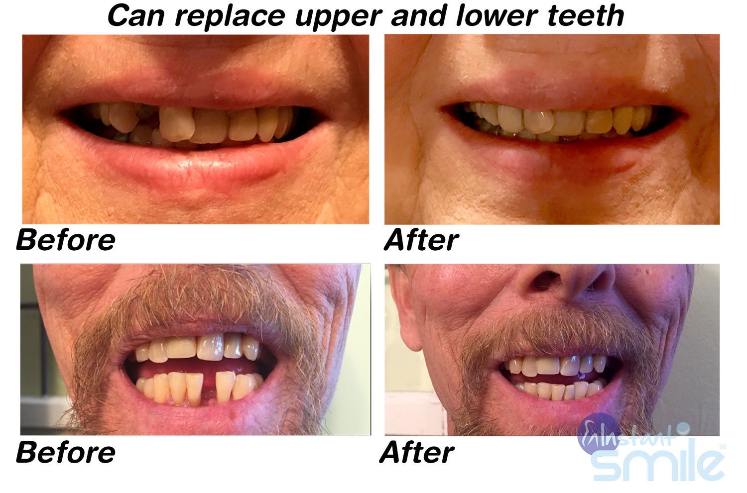 Patented temporary tooth repair kit components