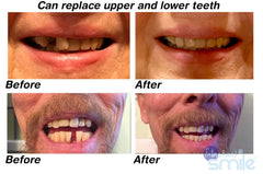 Patented temporary tooth repair kit components
