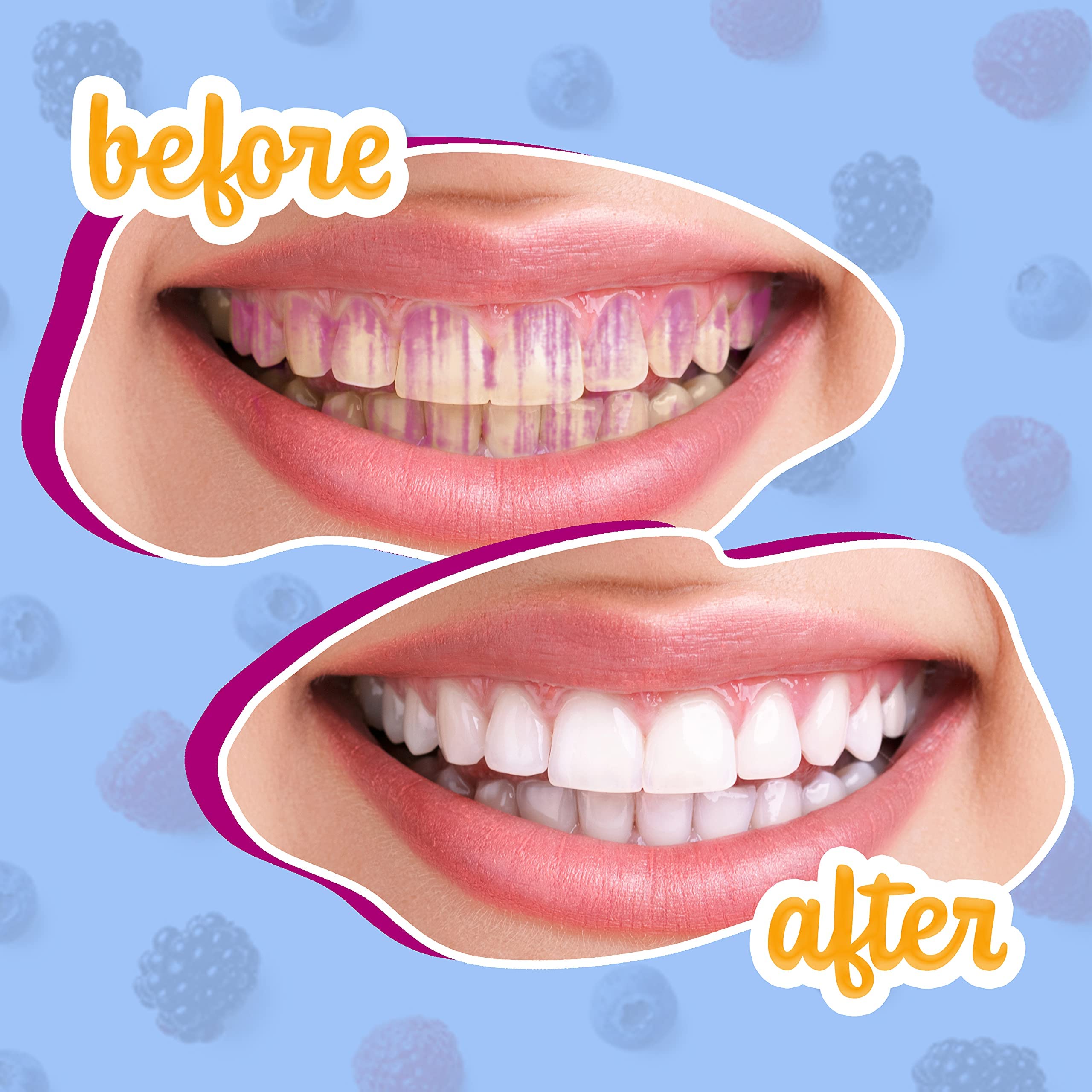 Teeth showing pink/purple plaque stain after disclosure