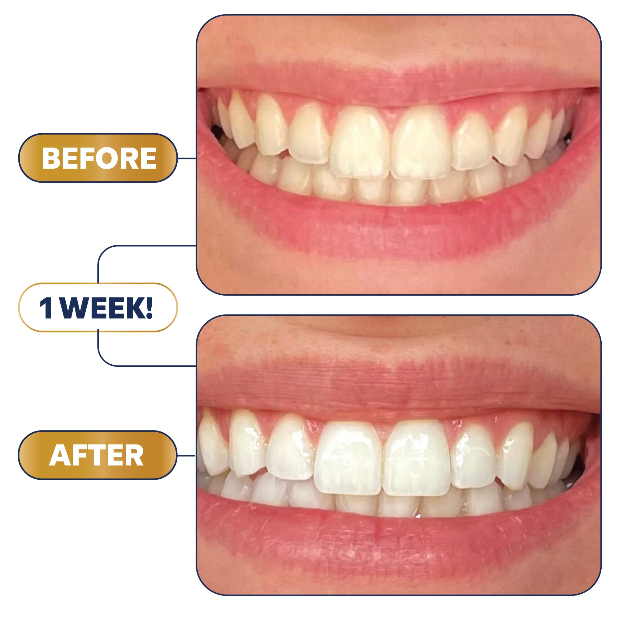 Enamel-safe whitening strips from Lumineux