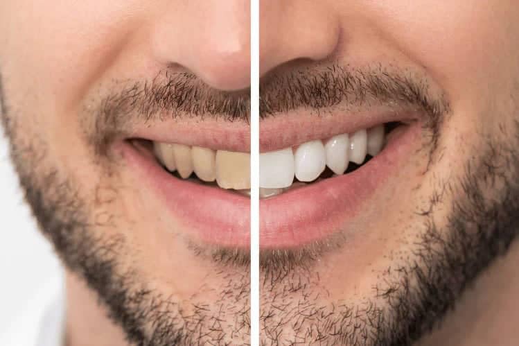 Whitening toothpaste removes tobacco and coffee stains