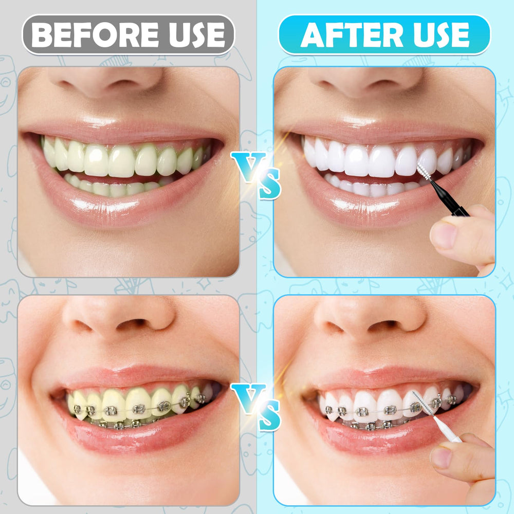 Interdental brush shown being inserted between teeth