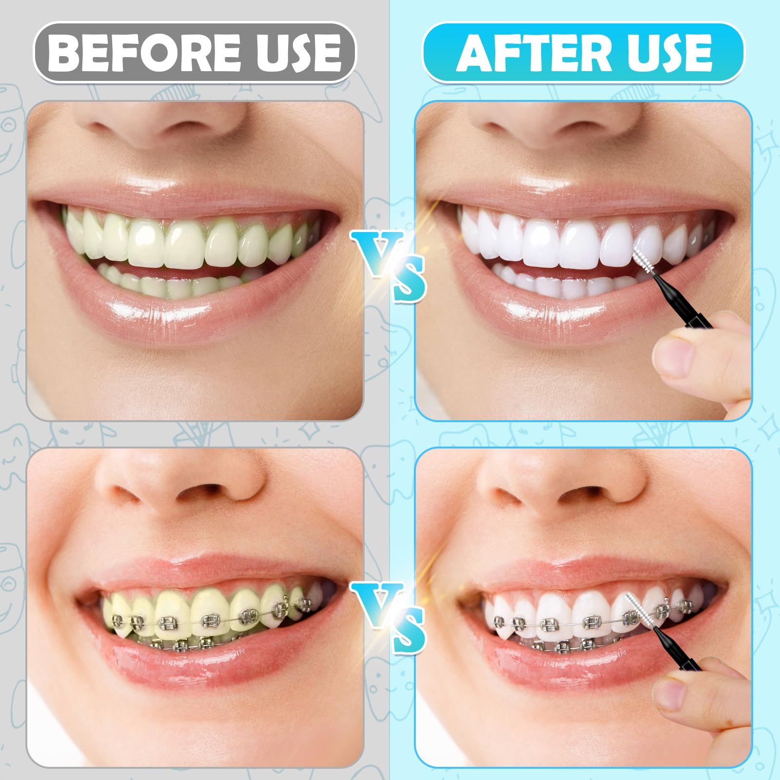 Interdental brushes for orthodontic care