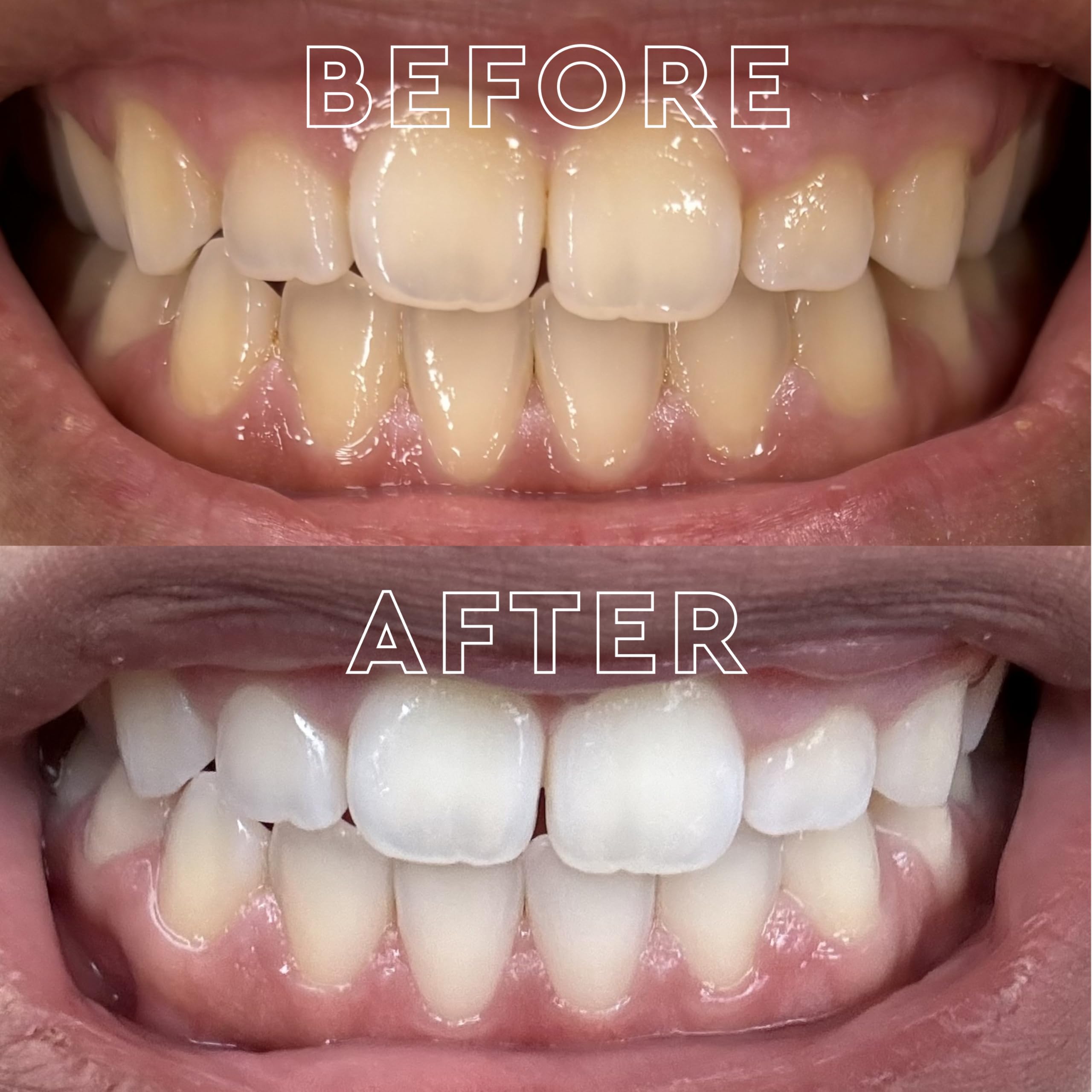 Platinum Express no rinse whitening strips in use