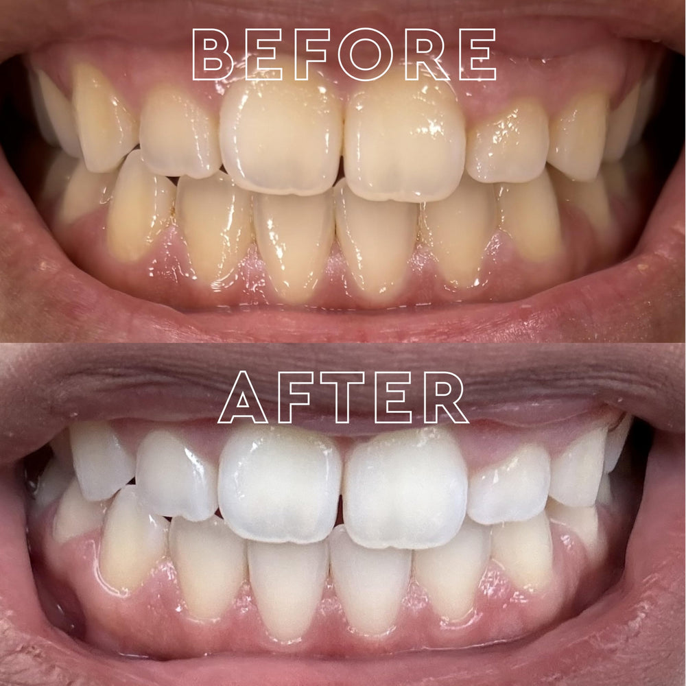 Platinum Express no rinse whitening strips in use