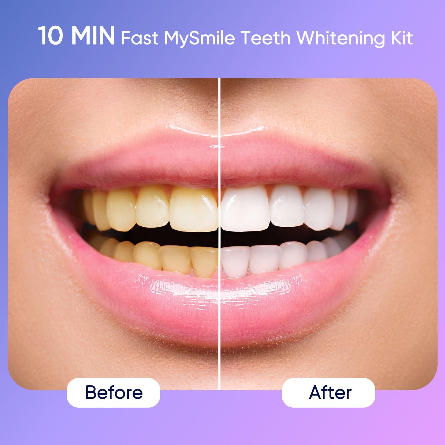LED light unit and whitening gel close-up